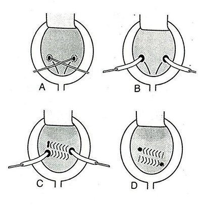 Chlamidia reflux