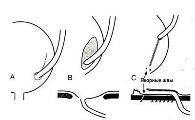 Chlamidia reflux