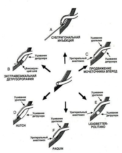 Chlamidia reflux