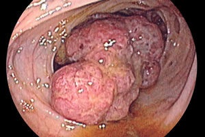 Rectal cancer 4 simptome etapă, cauze, metode de tratament