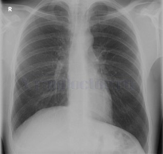 Diferențele și avantajele radiografiei toracice și fluorografice
