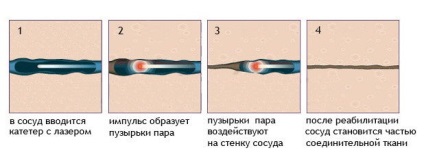 Reticular varicose ce este?