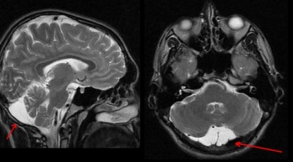 Chistul retrocrerebelar al creierului - ce este?