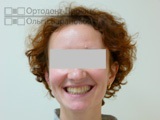 Rezultatele tratamentului ortodontic al aglomerării dinților - наталья к, 34 de ani