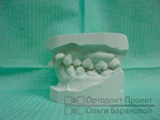 Rezultatele tratamentului ortodontic al aglomerării dinților - наталья к, 34 de ani