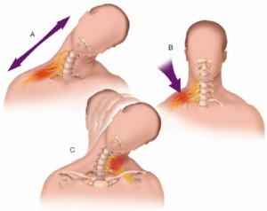 Plexita de col uterin - înfrângerea plexurilor nervoase din regiunea cervicală