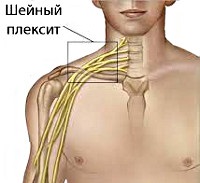 Nyaki plexitis - okai, tünetei, diagnózisa és kezelése