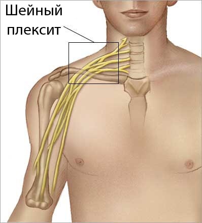 Simptomele plexitei cervicale, tratamentul, prevenirea, cauzele bolii