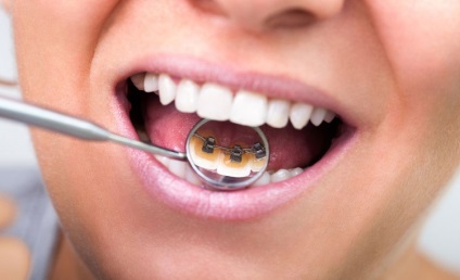 Съвременни техники за корекция оклузия стоматология