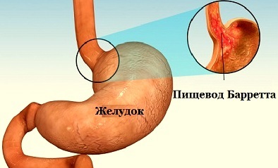 Tratamentul modern al esofagului barretului la clinica din Assuta