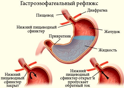 Tratamentul modern al esofagului barretului la clinica din Assuta