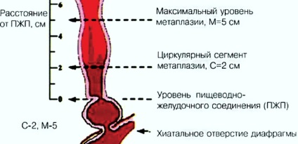 Tratamentul modern al esofagului barretului la clinica din Assuta