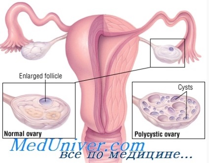 Teoria genezei suprarenale a ovarelor polichistice