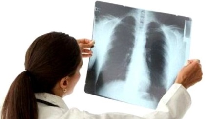 Traumatic pneumonie pneumonie cu traumatism închis