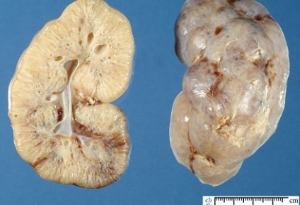 Uzi glandele suprarenale (prelegere pe diagnostician) - informații despre sănătate