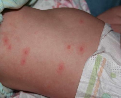 Varicela - simptome, fotografie, tratament, perioada de incubatie a varicelei