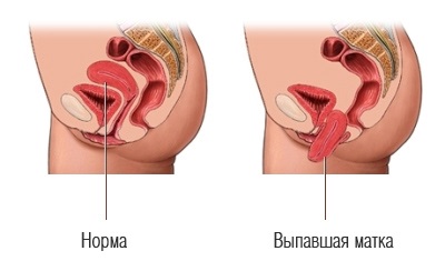 Pierderea uterului la femei după naștere