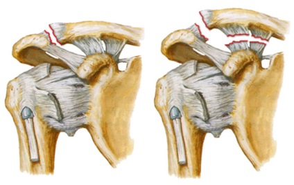 Dislocarea inelelor de tratament ale claviculei și a anvelopelor medicale