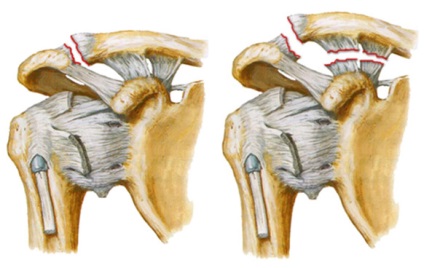 Вивих ключиці лікування кільця і ​​медичні шини