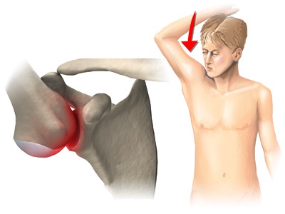 Dislocarea inelelor de tratament ale claviculei și a anvelopelor medicale