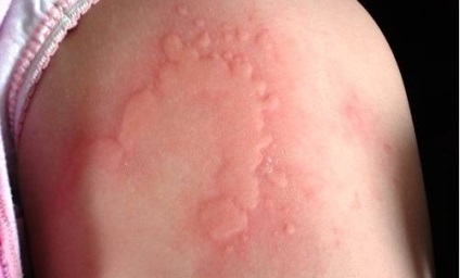 Alergia rece - cauze, simptome, tratamentul manifestărilor de reacție la frig