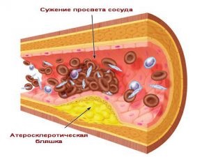 Хронічна гіпертонія лікування, причини, ускладнення