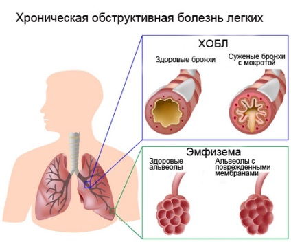 Boala pulmonară obstructivă cronică (hobblers)
