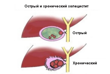 Colecistită cronică la un copil cauzează, simptome, tratament, en-babyhealth