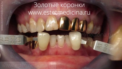 Coroane de dinți tipuri, care sunt cele mai bune, revista online