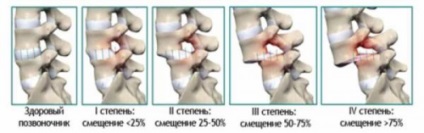 Antelopete vertebra - ceea ce este și ce este tratamentul