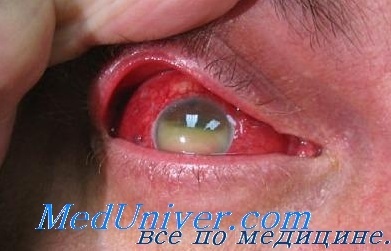 Terapia antibacteriană a infecției oculare