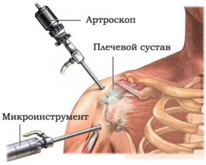 Artroscopia articulației umărului reprezintă costul și metodologia