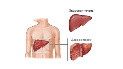 Asciții cu ciroză hepatică câți trăiesc