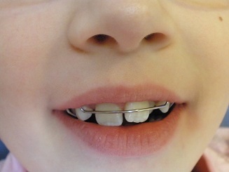 Ce trebuie să faceți dacă un copil are un dinte care crește din gură