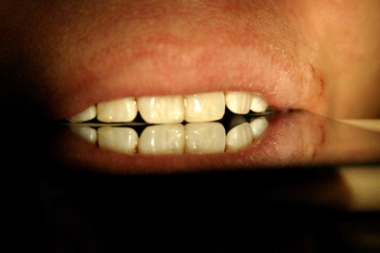 Articole privind restaurarea dinților