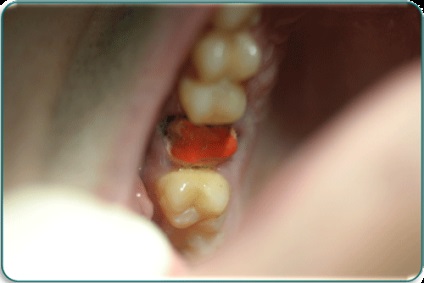 Articole privind restaurarea dinților