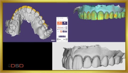 Revista dentară, galerie foto, caz clinic Nr. 45 restaurare naturală a DSD