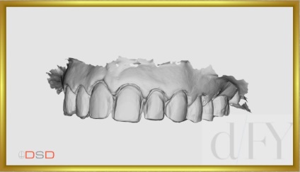 Revista dentară, galerie foto, caz clinic Nr. 45 restaurare naturală a DSD