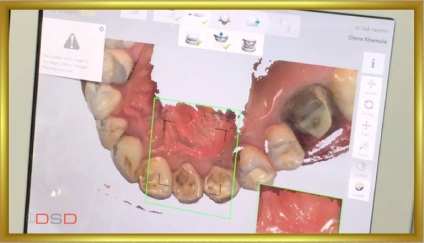 Revista dentară, galerie foto, caz clinic Nr. 45 restaurare naturală a DSD
