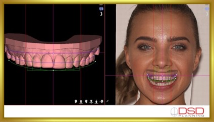 Revista dentară, galerie foto, caz clinic Nr. 45 restaurare naturală a DSD