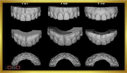 Revista dentară, galerie foto, caz clinic Nr. 45 restaurare naturală a DSD