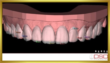 Revista dentară, galerie foto, caz clinic Nr. 45 restaurare naturală a DSD