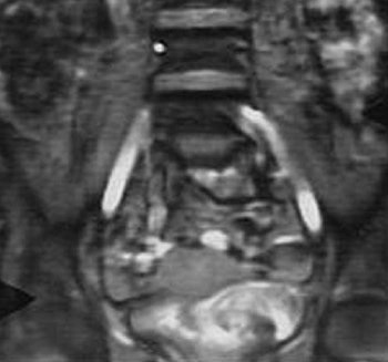 Diagnosticul bolilor ovariene