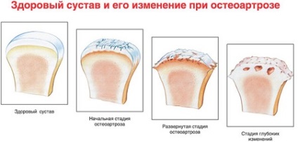 Életmód, egészség élelmiszer ízületek osteoarthritis menü, receptek