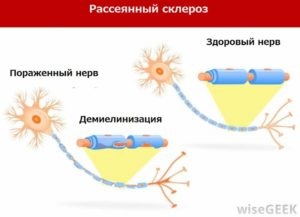 Dieta cu scleroză multiplă, cât mai bine alegeți