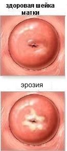 Eroziunea colului uterin - simptome, cauze, tratament