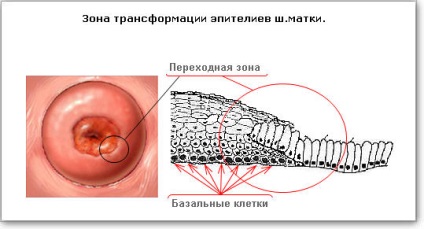 Eroziunea cervixului este o boală sau o normă