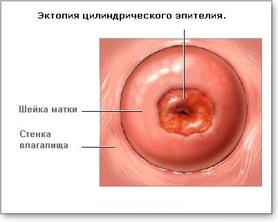 Eroziunea cervixului este o boală sau o normă