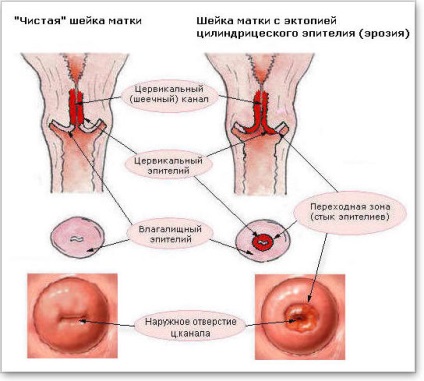 Eroziunea cervixului este o boală sau o normă