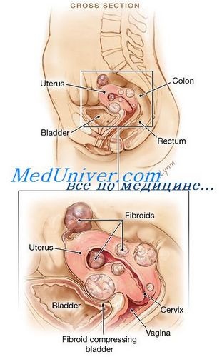 Foliculă în menopauză în dimensiuni mari, menopauză, menopauză